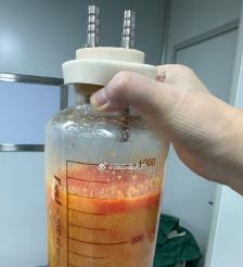 太康水动力吸脂手术要做多久？